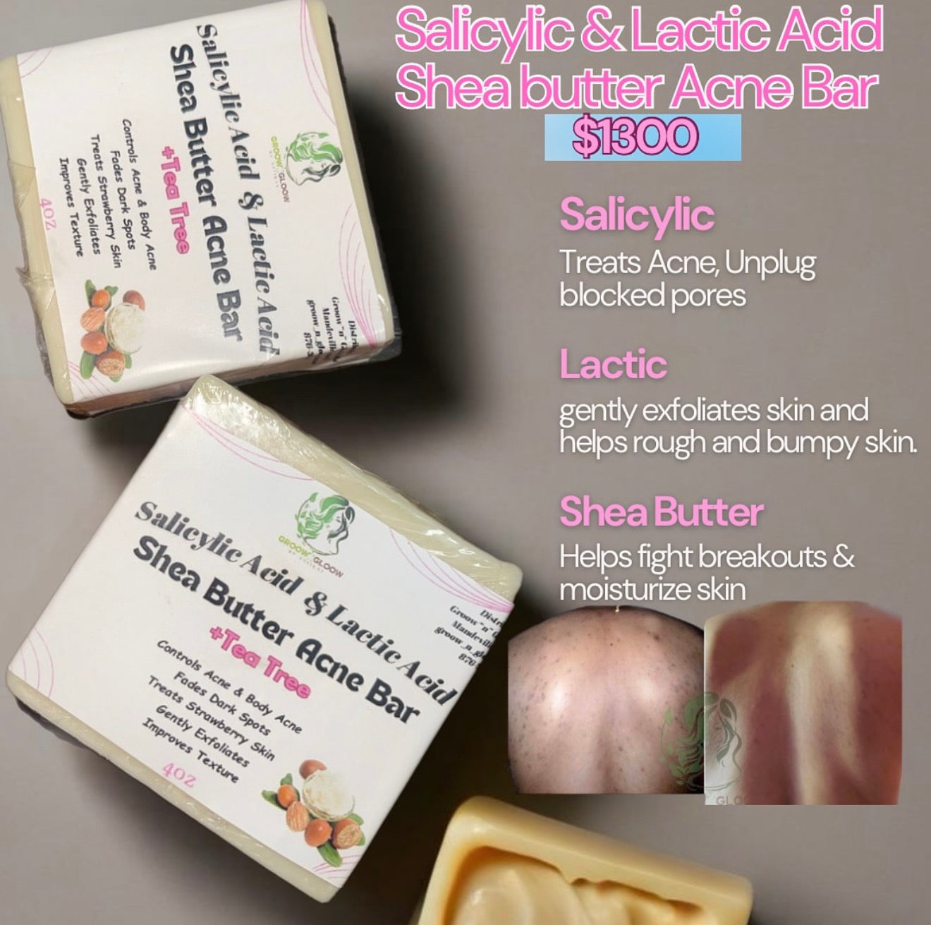 Salicylic Shea butter acne bar